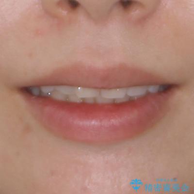 インビザラインによる矯正治療と奥歯のインプラント治療の治療前(顔貌)