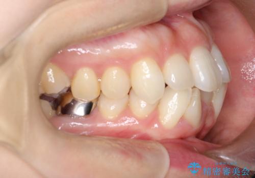 ワイヤー矯正で前歯のデコボコを改善|下顎前歯1本抜歯でバランスの良い歯並びへの治療前