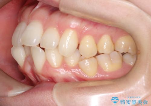 ワイヤー矯正で前歯のデコボコを改善|下顎前歯1本抜歯でバランスの良い歯並びへの治療前