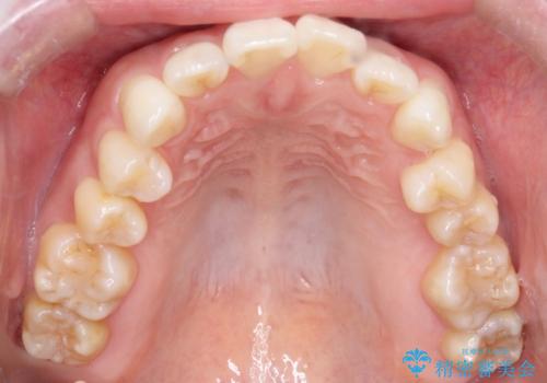 ワイヤー矯正で前歯のデコボコを改善|下顎前歯1本抜歯でバランスの良い歯並びへの治療前