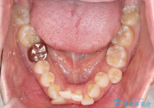 ワイヤー矯正で前歯のデコボコを改善|下顎前歯1本抜歯でバランスの良い歯並びへの治療前