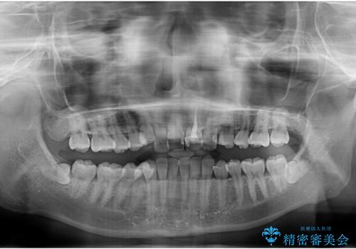 全体的なデコボコが気になる。拡大装置を併用したワイヤー矯正の治療前