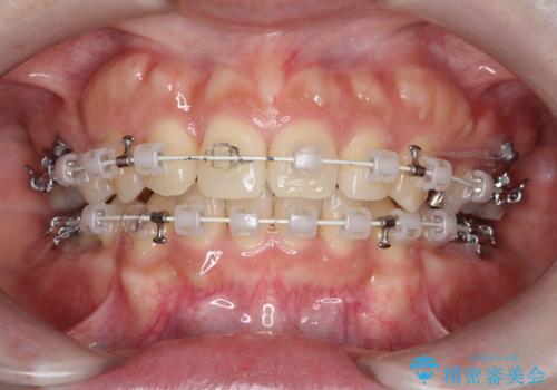 前歯のデコボコを抜歯矯正で改善|アンカースクリューで口元もスッキリの治療中