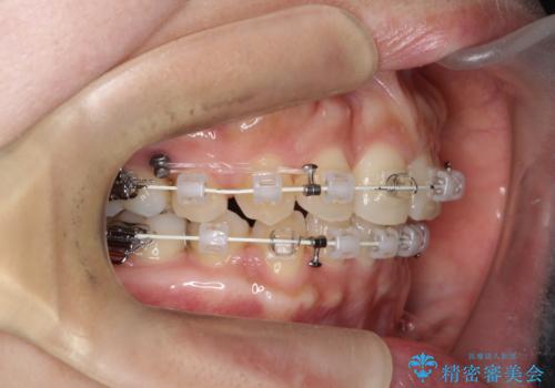 前歯のデコボコを抜歯矯正で改善|アンカースクリューで口元もスッキリの治療中