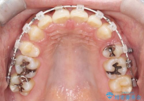 前歯のデコボコを抜歯矯正で改善|アンカースクリューで口元もスッキリの治療中