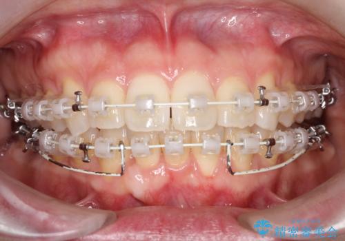 ワイヤー矯正で前歯のデコボコを改善|下顎前歯1本抜歯でバランスの良い歯並びへの治療中