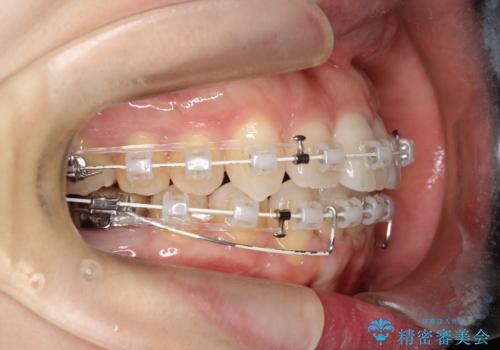 ワイヤー矯正で前歯のデコボコを改善|下顎前歯1本抜歯でバランスの良い歯並びへの治療中