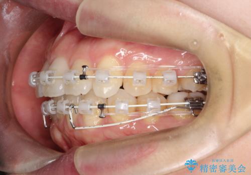 ワイヤー矯正で前歯のデコボコを改善|下顎前歯1本抜歯でバランスの良い歯並びへの治療中