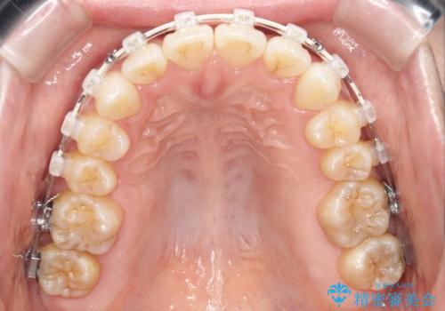 ワイヤー矯正で前歯のデコボコを改善|下顎前歯1本抜歯でバランスの良い歯並びへの治療中