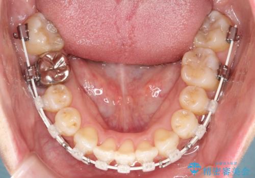 ワイヤー矯正で前歯のデコボコを改善|下顎前歯1本抜歯でバランスの良い歯並びへの治療中