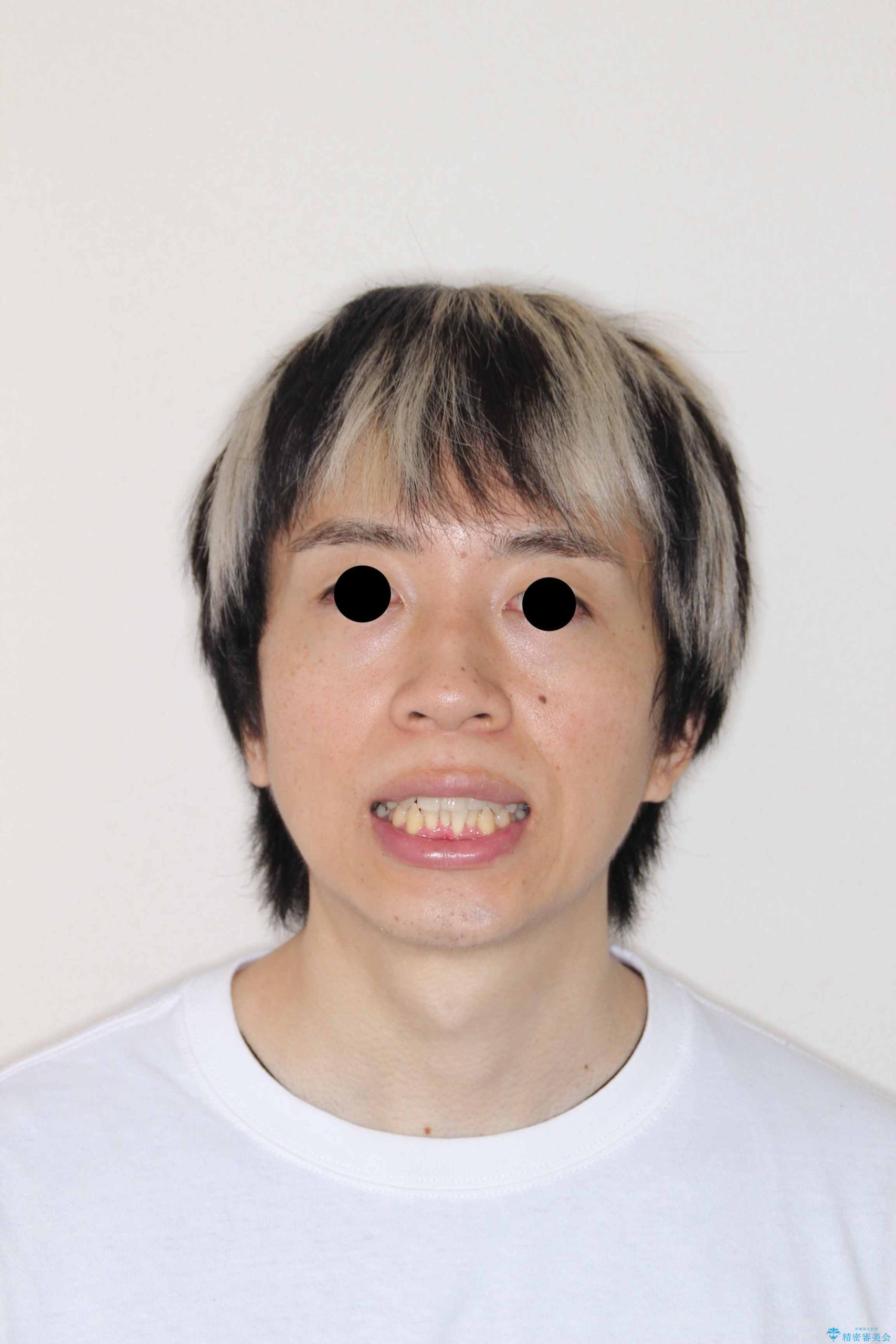 モニター|歯のでこぼこと前歯が引っ込んでいるのを治したい|抜歯矯正で歯のデコボコと正中を改善|ワイヤー矯正の治療前(顔貌)