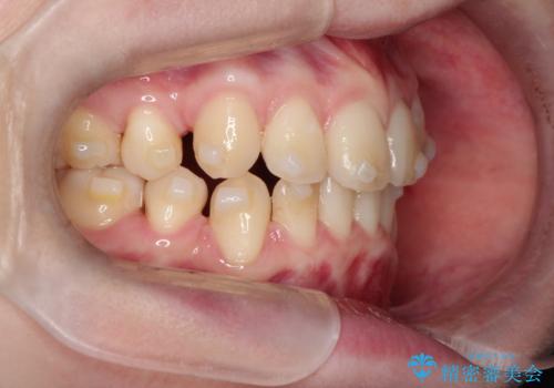 インビザラインで八重歯を抜歯矯正|ゴムかけを活用し美しい歯並びへの治療中