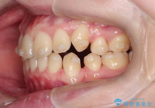 インビザラインで八重歯を抜歯矯正|ゴムかけを活用し美しい歯並びへの治療中