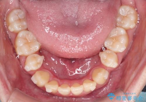 インビザラインで八重歯を抜歯矯正|ゴムかけを活用し美しい歯並びへの治療中
