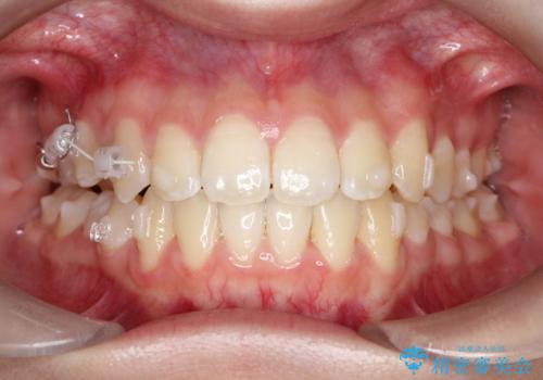 右上小臼歯の捻転を改善|インビザラインと部分ワイヤー矯正のコンビネーション治療の治療中