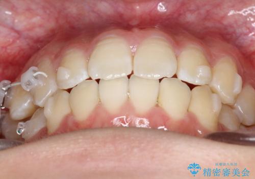 右上小臼歯の捻転を改善|インビザラインと部分ワイヤー矯正のコンビネーション治療の治療中