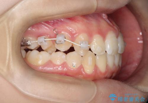 右上小臼歯の捻転を改善|インビザラインと部分ワイヤー矯正のコンビネーション治療の治療中