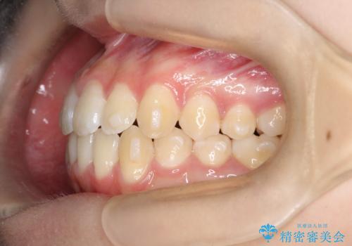 右上小臼歯の捻転を改善|インビザラインと部分ワイヤー矯正のコンビネーション治療の治療中