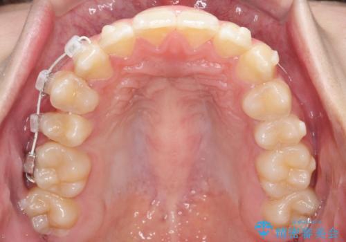 右上小臼歯の捻転を改善|インビザラインと部分ワイヤー矯正のコンビネーション治療の治療中