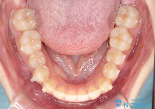 右上小臼歯の捻転を改善|インビザラインと部分ワイヤー矯正のコンビネーション治療の治療中