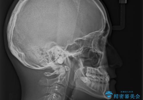 全体的なデコボコが気になる。拡大装置を併用したワイヤー矯正の治療前