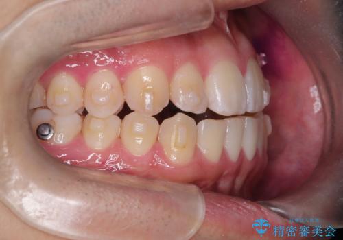 「インビザラインで八重歯をきれいに改善|遠心移動とIPRでバランスの良い歯並びへ」の治療中
