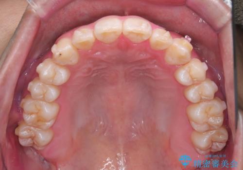 「インビザラインで八重歯をきれいに改善|遠心移動とIPRでバランスの良い歯並びへ」の治療中