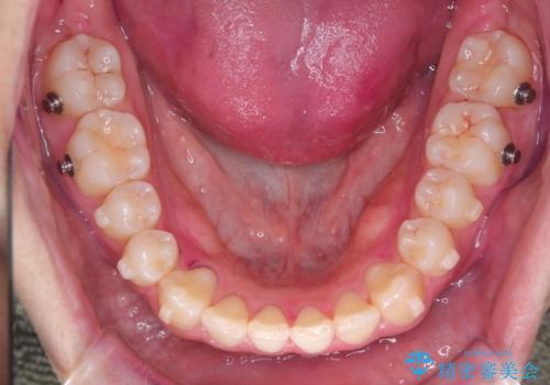 「インビザラインで八重歯をきれいに改善|遠心移動とIPRでバランスの良い歯並びへ」の治療中
