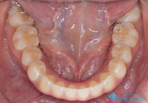 「フルリンガル矯正|アンカースクリューを活用し正中を整えた症例」の治療後