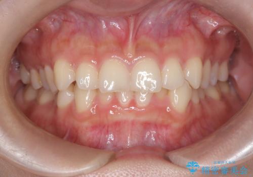 前歯のガタガタをインビザラインで改善|IPRと遠心移動でスムーズな歯並びへの治療前