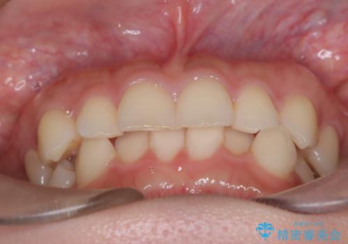 前歯のガタガタをインビザラインで改善|IPRと遠心移動でスムーズな歯並びへの治療前