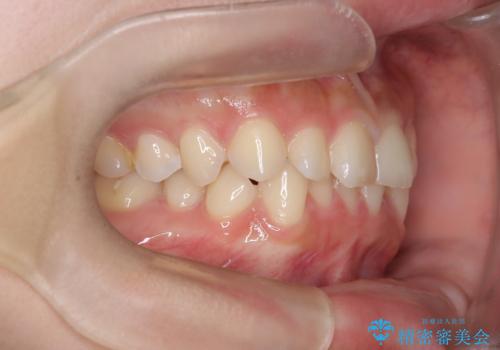前歯のガタガタをインビザラインで改善|IPRと遠心移動でスムーズな歯並びへの治療前