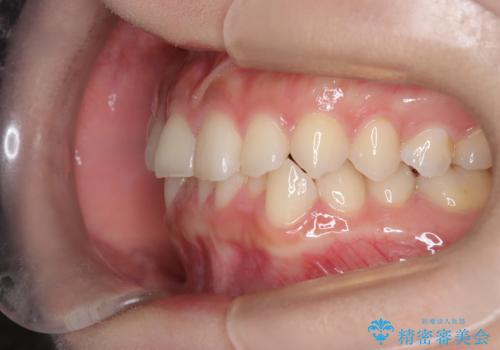 前歯のガタガタをインビザラインで改善|IPRと遠心移動でスムーズな歯並びへの治療前