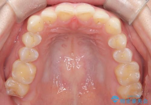 前歯のガタガタをインビザラインで改善|IPRと遠心移動でスムーズな歯並びへの治療前