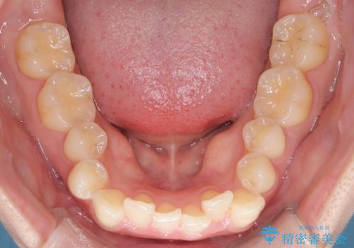 前歯のガタガタをインビザラインで改善|IPRと遠心移動でスムーズな歯並びへの治療前