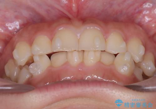 前歯のガタガタをインビザラインで改善|IPRと遠心移動でスムーズな歯並びへの治療中