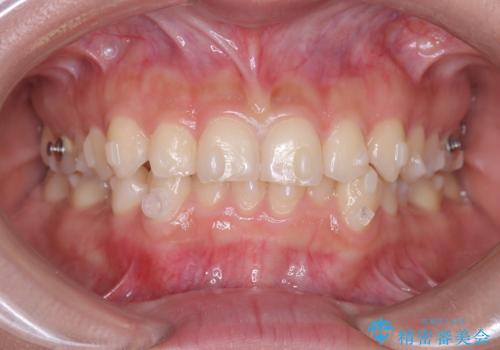 前歯のガタガタをインビザラインで改善|IPRと遠心移動でスムーズな歯並びへの治療中