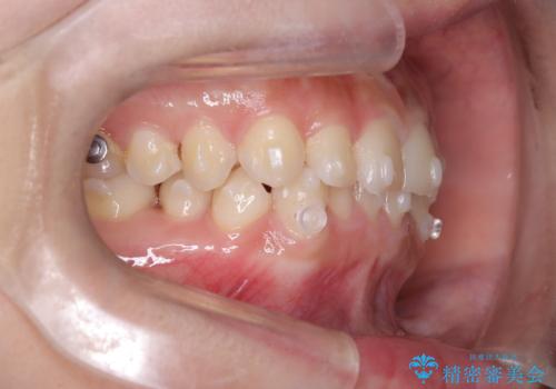 前歯のガタガタをインビザラインで改善|IPRと遠心移動でスムーズな歯並びへの治療中