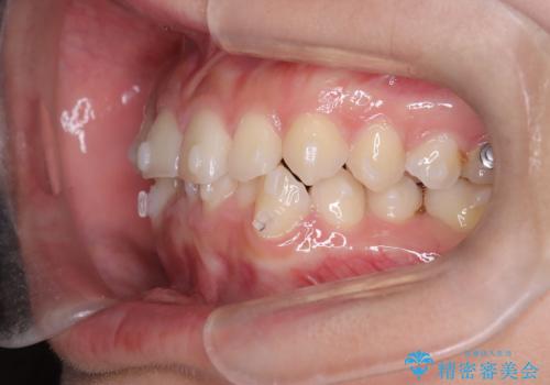 前歯のガタガタをインビザラインで改善|IPRと遠心移動でスムーズな歯並びへの治療中