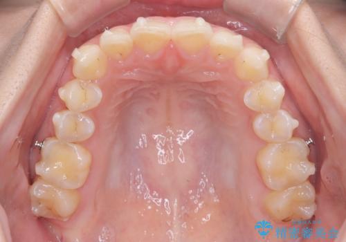 前歯のガタガタをインビザラインで改善|IPRと遠心移動でスムーズな歯並びへの治療中