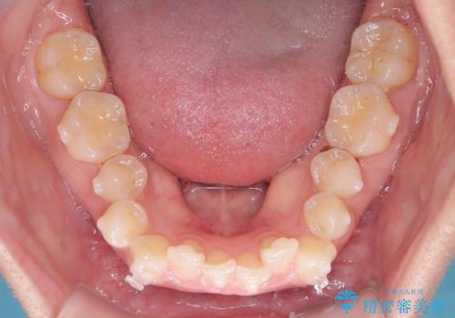 前歯のガタガタをインビザラインで改善|IPRと遠心移動でスムーズな歯並びへの治療中