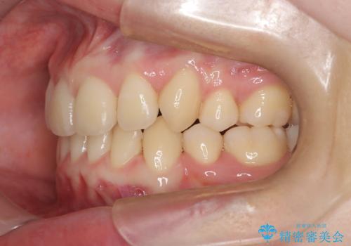 インビザラインで八重歯を抜歯矯正|ゴムかけを活用し美しい歯並びへの治療後