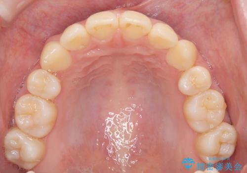 インビザラインで八重歯を抜歯矯正|ゴムかけを活用し美しい歯並びへの治療後