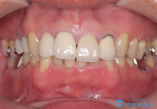 前歯4本のセラミック治療|抜歯即時インプラント+歯根端切除術で機能と美しさを回復の治療前