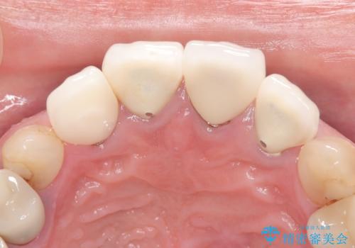 前歯4本のセラミック治療|抜歯即時インプラント+歯根端切除術で機能と美しさを回復の治療前