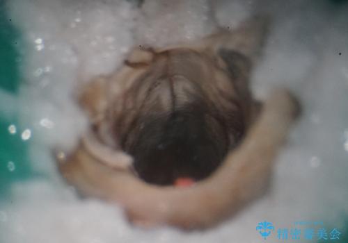 前歯4本のセラミック治療|抜歯即時インプラント+歯根端切除術で機能と美しさを回復の治療前