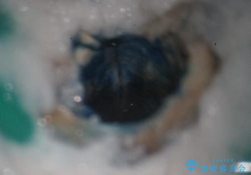 前歯4本のセラミック治療|抜歯即時インプラント+歯根端切除術で機能と美しさを回復の治療中