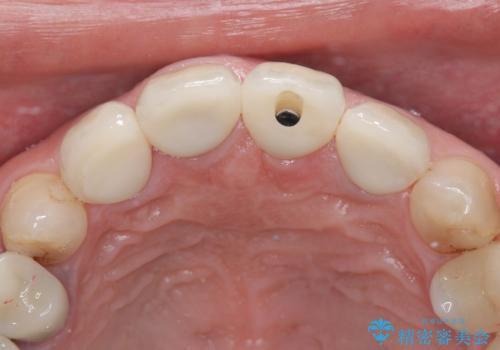 前歯4本のセラミック治療|抜歯即時インプラント+歯根端切除術で機能と美しさを回復の治療中