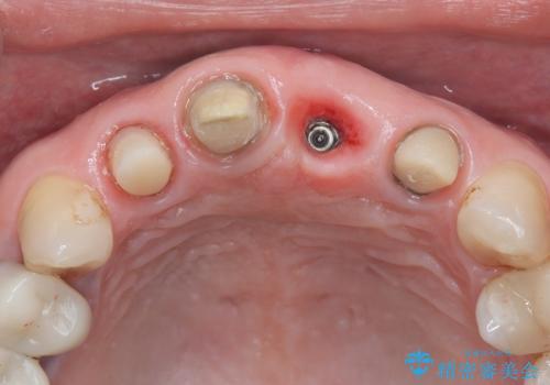 前歯4本のセラミック治療|抜歯即時インプラント+歯根端切除術で機能と美しさを回復の治療中