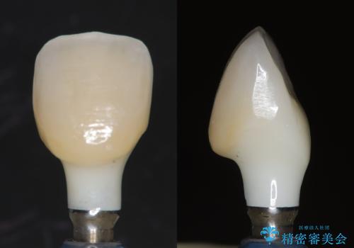 前歯4本のセラミック治療|抜歯即時インプラント+歯根端切除術で機能と美しさを回復